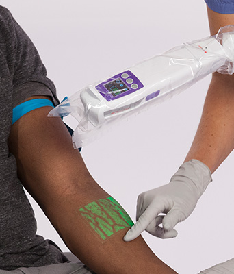 AccuVein Vein Visualization-Improves IV 1-Stick Success 3.5x