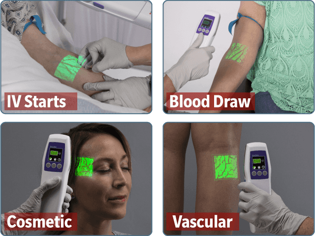 AccuVein Vein Visualization-Improves IV 1-Stick Success 3.5x